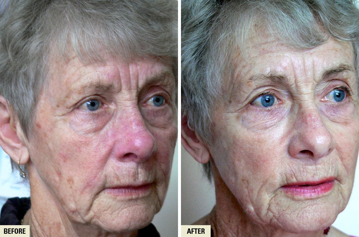 LASER GENESIS WOMAN BA