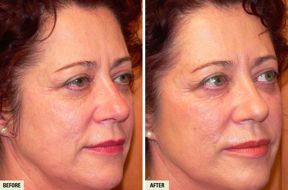 LORRAINE DERMAL FILLER 2