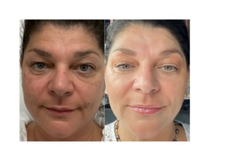 Why Experience Matters More Than Price in Dermal Fillers and Anti-Wrinkle Treatments