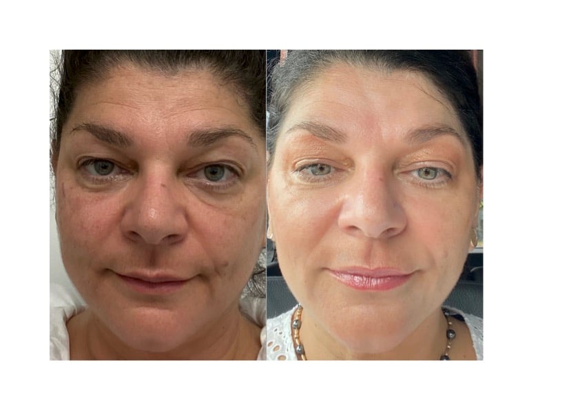PDF VAMPIRE FACIAL + DERMAL FILLERS 