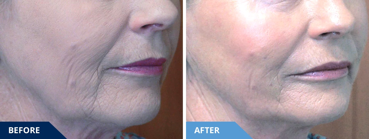 before-after-6b-blue-jpg-3