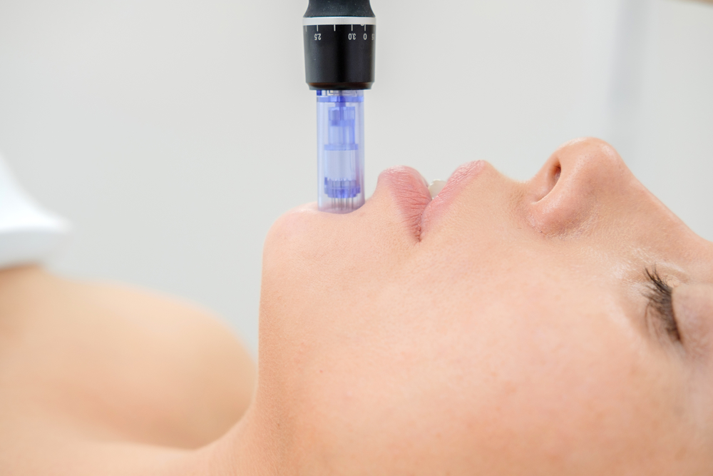 DErmapen on chin