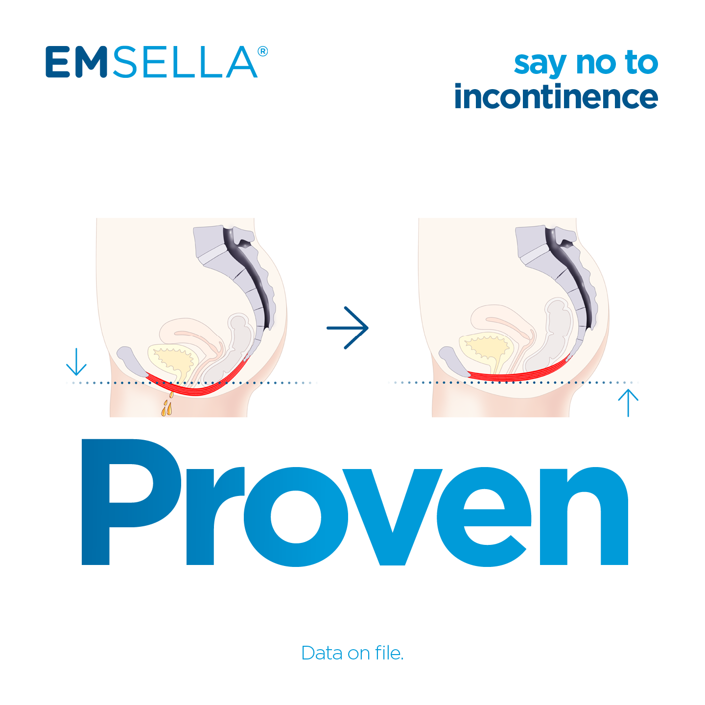 Emsella® Chair for Bladder control and Better Sex- Men and Women